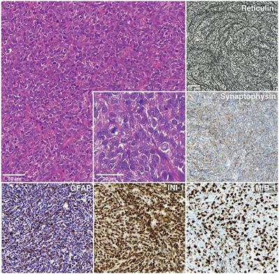 Concurrent IDH1 and SMARCB1 Mutations in Pediatric Medulloblastoma: A Case Report